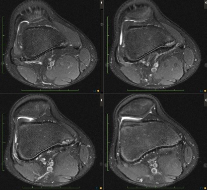 Figure 4 for case Cortical desmoid